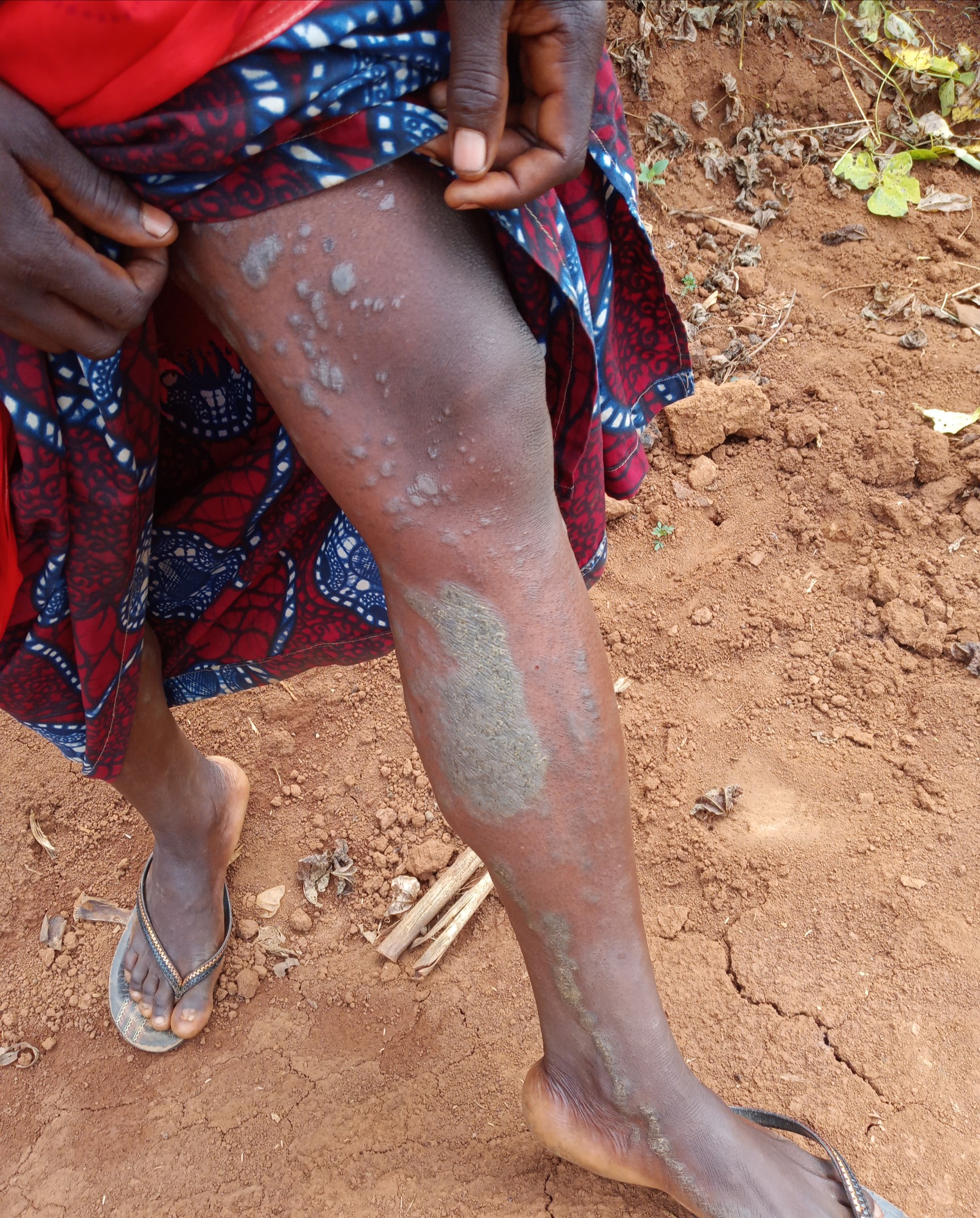 Nkombo: Hari umubyeyi urembejwe n'indwara y'uruhu ahitamo kwivurisha imiti y'inyanya kubera kubura Mituweli